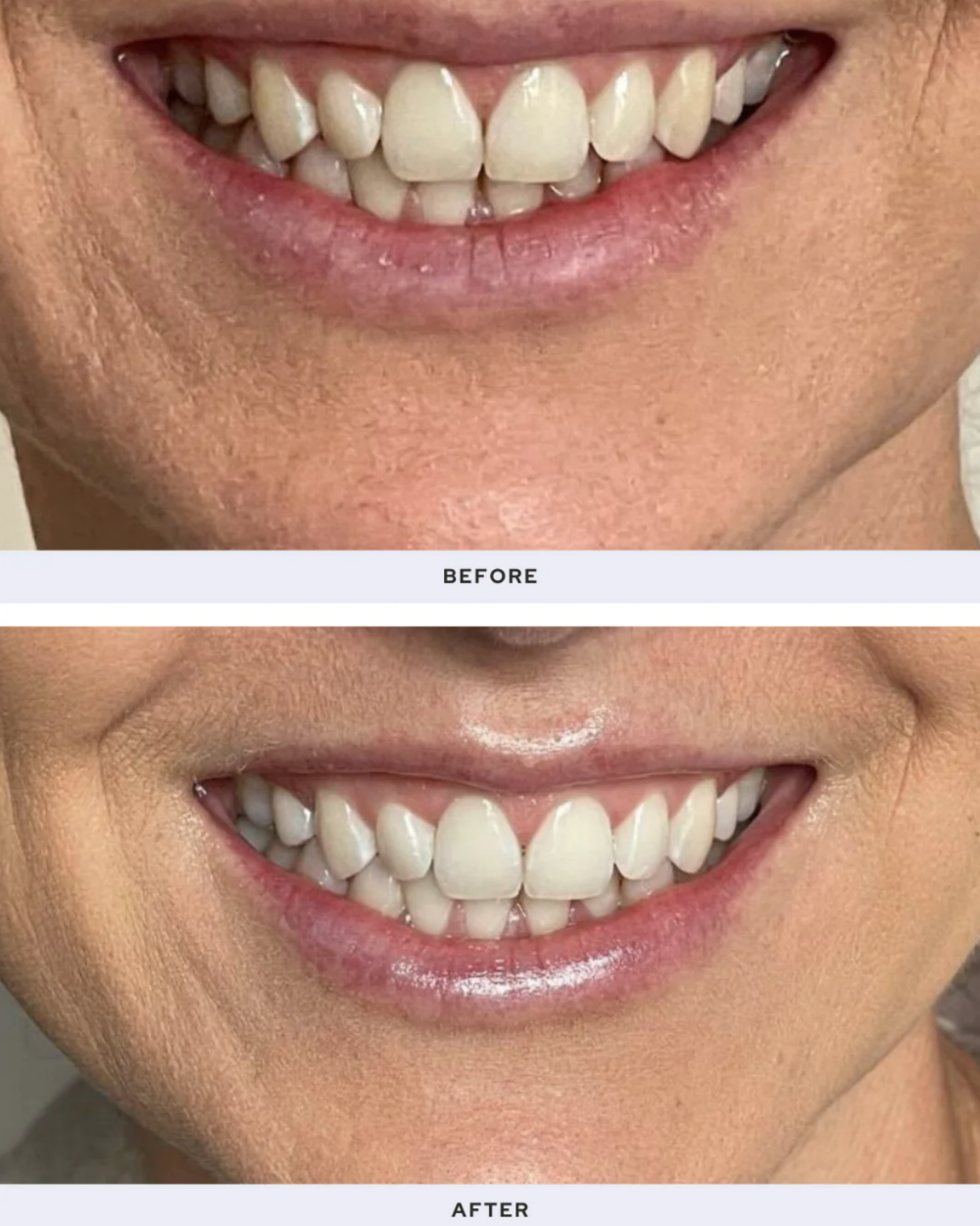 Spotlight Oral Care Professional LED Teeth Whitening System Refill Kit before and after on woman's teeth