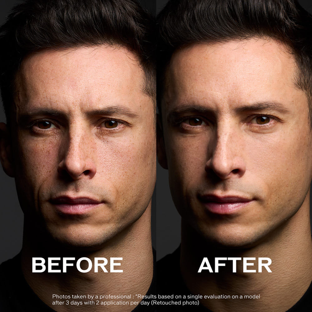 Before and after comparison of a person's face with 'Before' on the left and 'After' on the right.